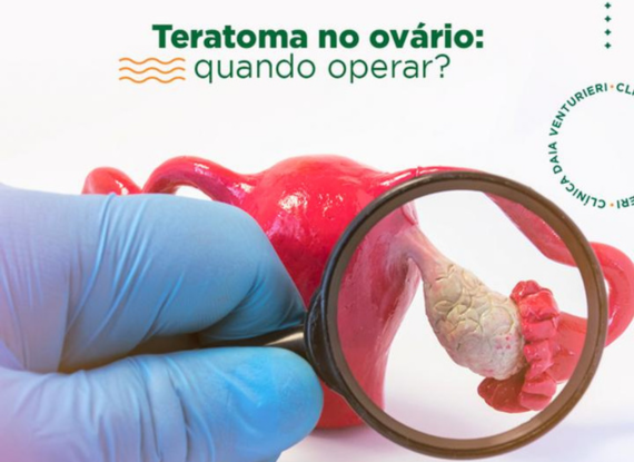 Banner do post Teratoma no ovário: quando operar?