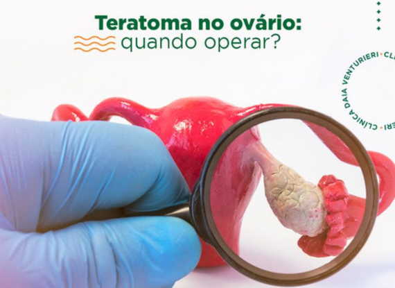 teratoma