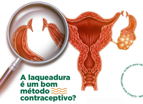 Banner do post A laqueadura é um bom método contraceptivo?